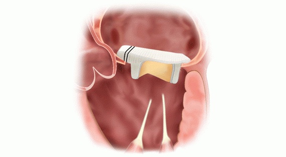 Митральный клапан Carpentier-Edwards PERIMOUNT Magna Mitral Ease - изображение 4