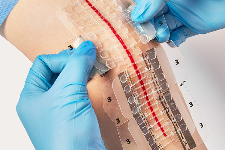 Фиксатор швов Foldable Skin Closure