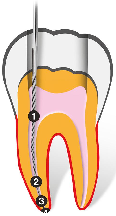 Апекслокатор Dentsply ProPex Pixi - изображение 4