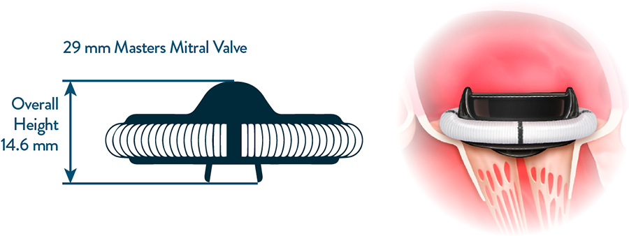 Аортальный механический клапан Abbott Regent - изображение 2